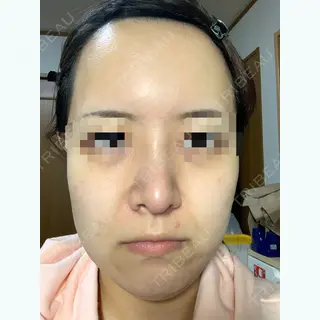 13日目の経過画像（1枚目）