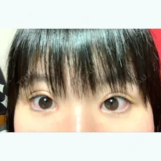 11日目の経過画像（1枚目）
