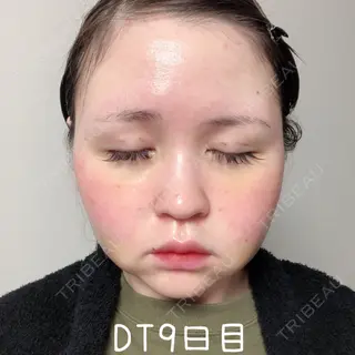 9日目の経過画像（2枚目）