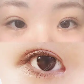 15日目の経過画像（1枚目）