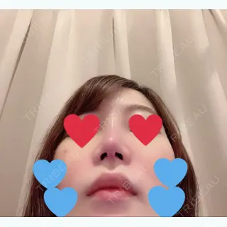7日目の経過画像（3枚目）