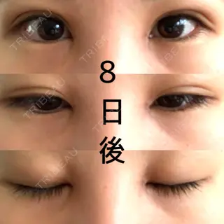 8日目の経過画像（1枚目）