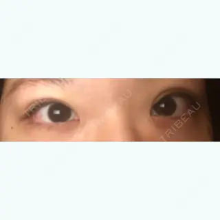 0日目の経過画像（2枚目）