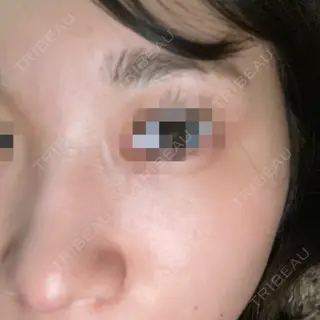 3日目の経過画像（2枚目）