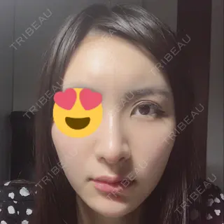 26日目の経過画像（1枚目）