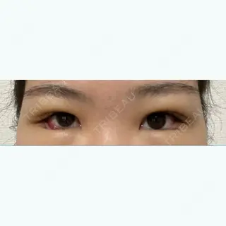 6日目の経過画像（1枚目）
