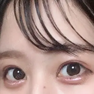 2日目の経過画像（1枚目）