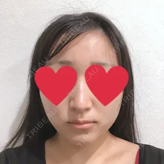 23日目の経過画像（1枚目）