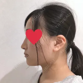 28日目の経過画像（2枚目）