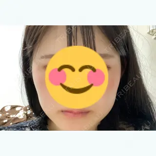 34日目の経過画像（2枚目）