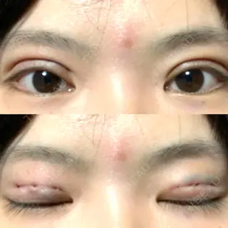 0日目の経過画像（1枚目）