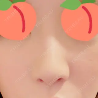 34日目の経過画像（2枚目）