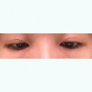 14日目の経過画像（2枚目）