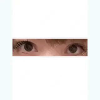 82日目の経過画像（1枚目）