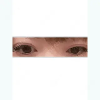 82日目の経過画像（2枚目）