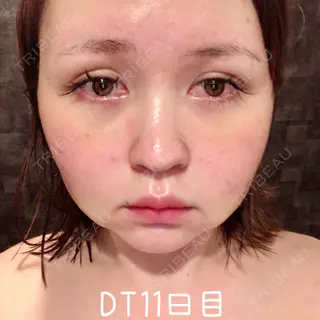 11日目の経過画像（1枚目）