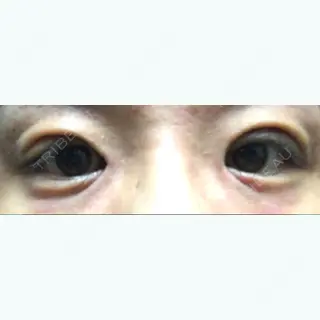 1日目の経過画像（1枚目）