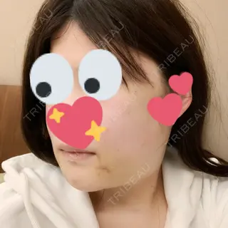 3日目の経過画像（2枚目）