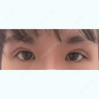 7日目の経過画像（1枚目）