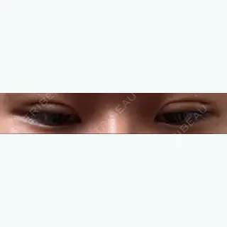 5日目の経過画像（3枚目）