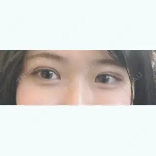 11日目の経過画像（1枚目）