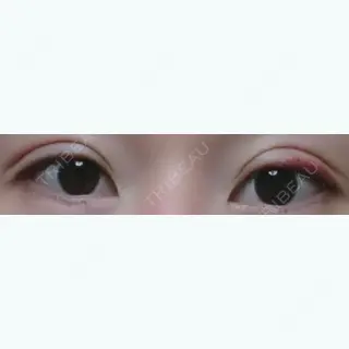 6日目の経過画像（1枚目）