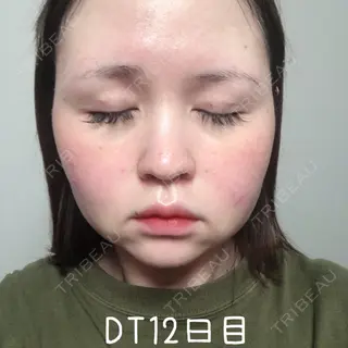 12日目の経過画像（2枚目）