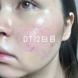 12日目の経過画像（3枚目）