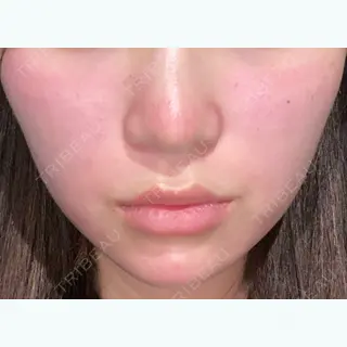 1日目の経過画像（2枚目）