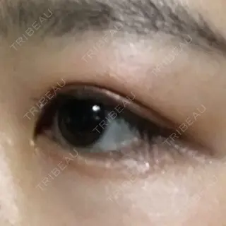 49日目の経過画像（3枚目）