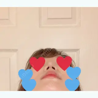 10日目の経過画像（3枚目）