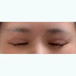 10日目の経過画像（2枚目）