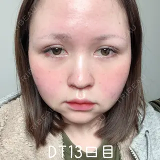 13日目の経過画像（1枚目）