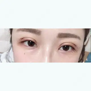 5日目の経過画像（1枚目）