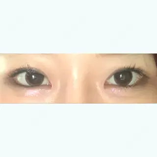 32日目の経過画像（1枚目）