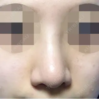 14日目の経過画像（2枚目）