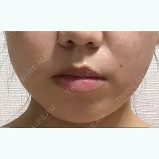 12日目の経過画像（1枚目）