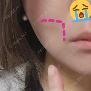 4日目の経過画像（2枚目）