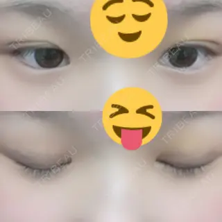 3日目の経過画像（1枚目）