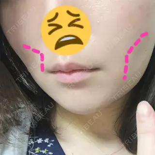 4日目の経過画像（1枚目）