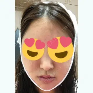 3日目の経過画像（1枚目）
