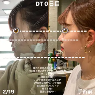 0日目の経過画像（1枚目）