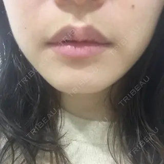 2日目の経過画像（1枚目）
