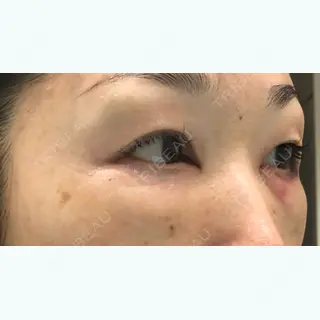 2日目の経過画像（2枚目）