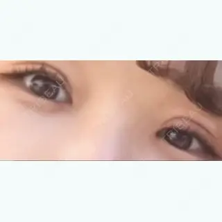11日目の経過画像（1枚目）
