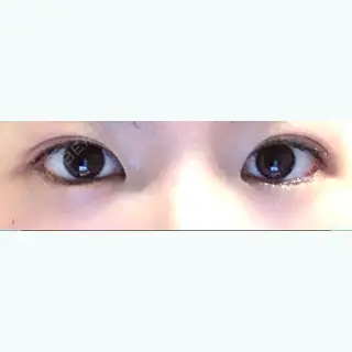 60日目の経過画像（1枚目）