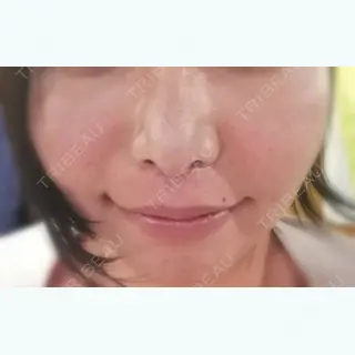 31日目の経過画像（1枚目）