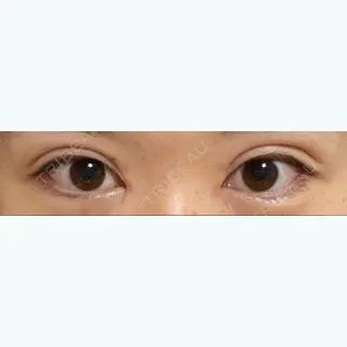18日目の経過画像（1枚目）