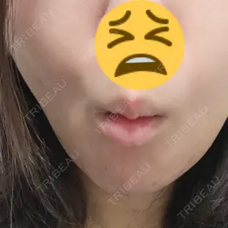 6日目の経過画像（1枚目）