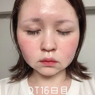 16日目の経過画像（2枚目）